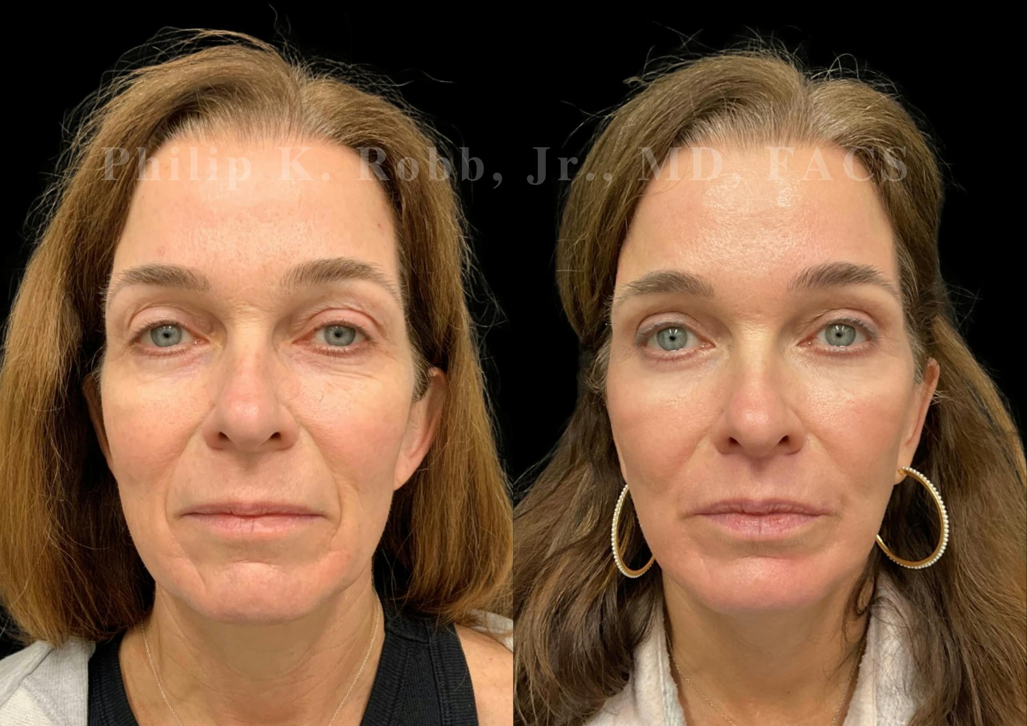 Upper Blepharoplasty Before & After Gallery - Patient 504058 - Image 1