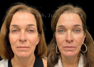 Upper Blepharoplasty Before & After Gallery - Patient 504058 - Image 1