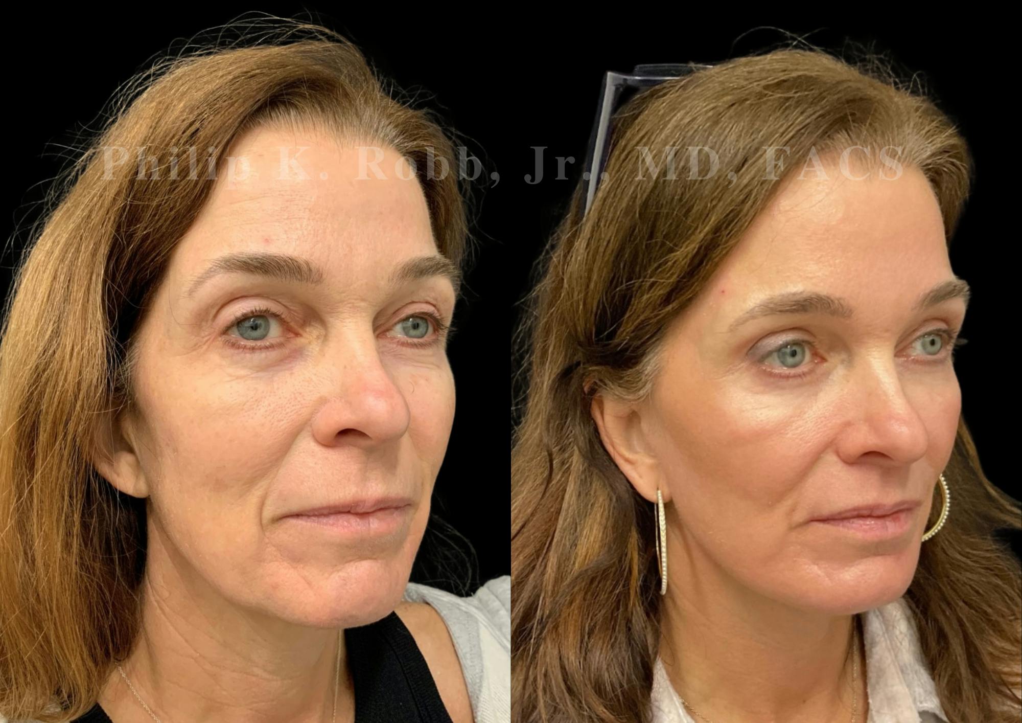 Upper Blepharoplasty Before & After Gallery - Patient 504058 - Image 4