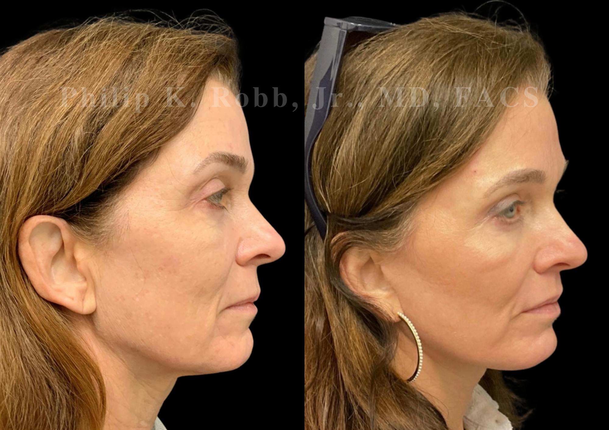 Upper Blepharoplasty Before & After Gallery - Patient 504058 - Image 5