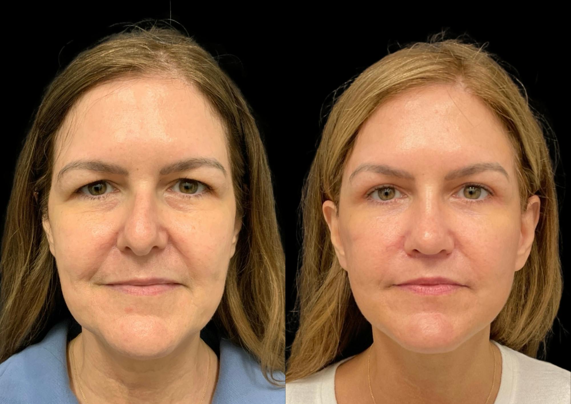 Laser Skin Resurfacing Before & After Gallery - Patient 171188 - Image 4