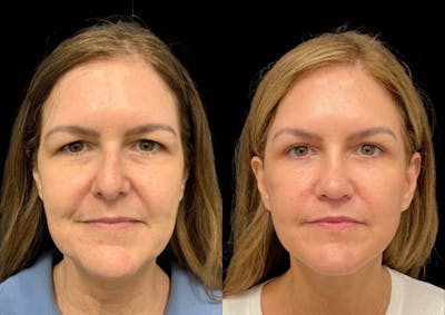 Upper Blepharoplasty Before & After Gallery - Patient 305459 - Image 1