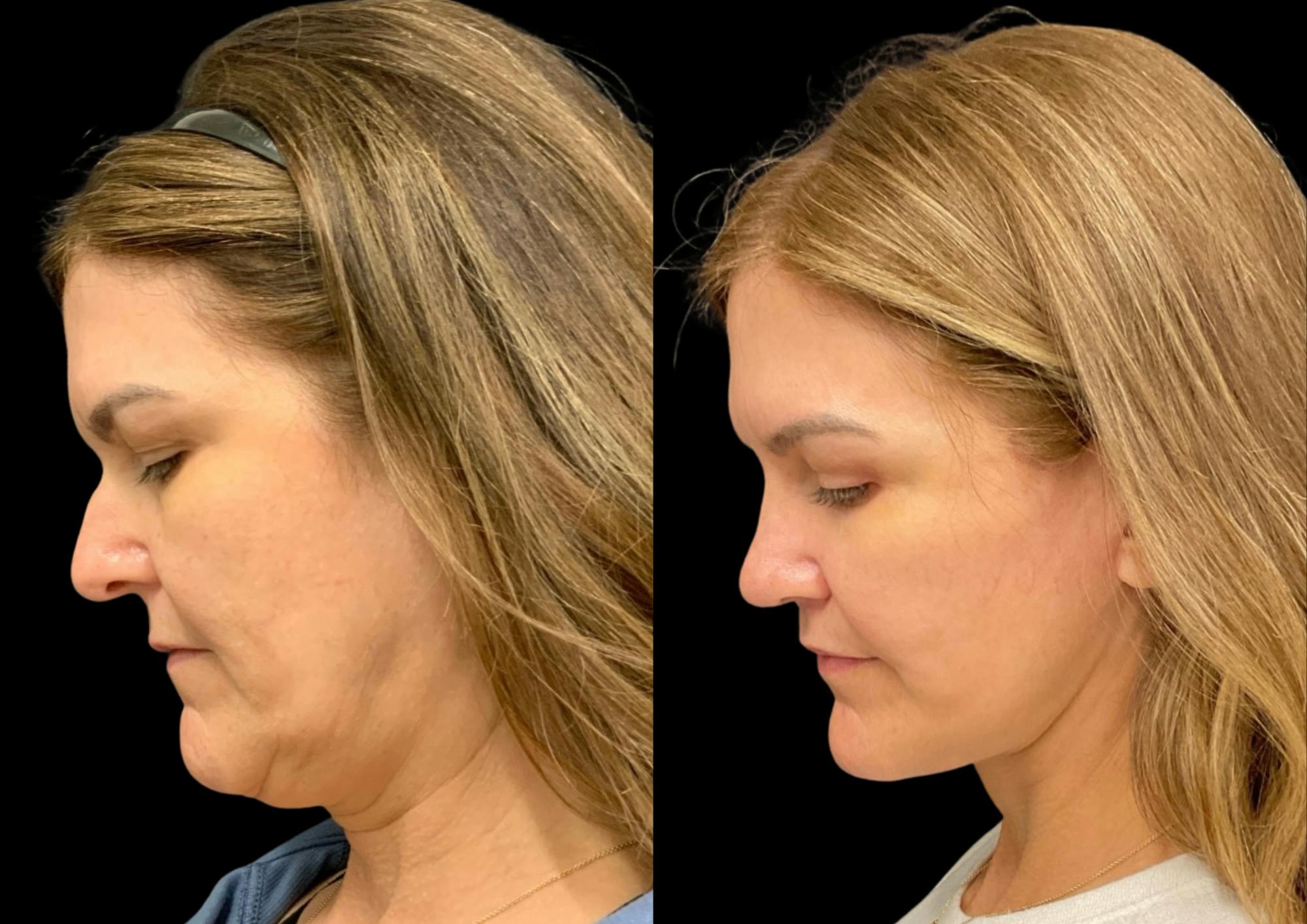 Laser Skin Resurfacing Before & After Gallery - Patient 171188 - Image 1