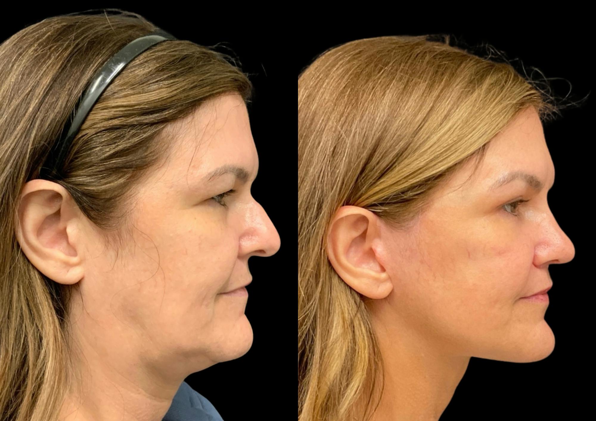 Laser Skin Resurfacing Before & After Gallery - Patient 171188 - Image 6
