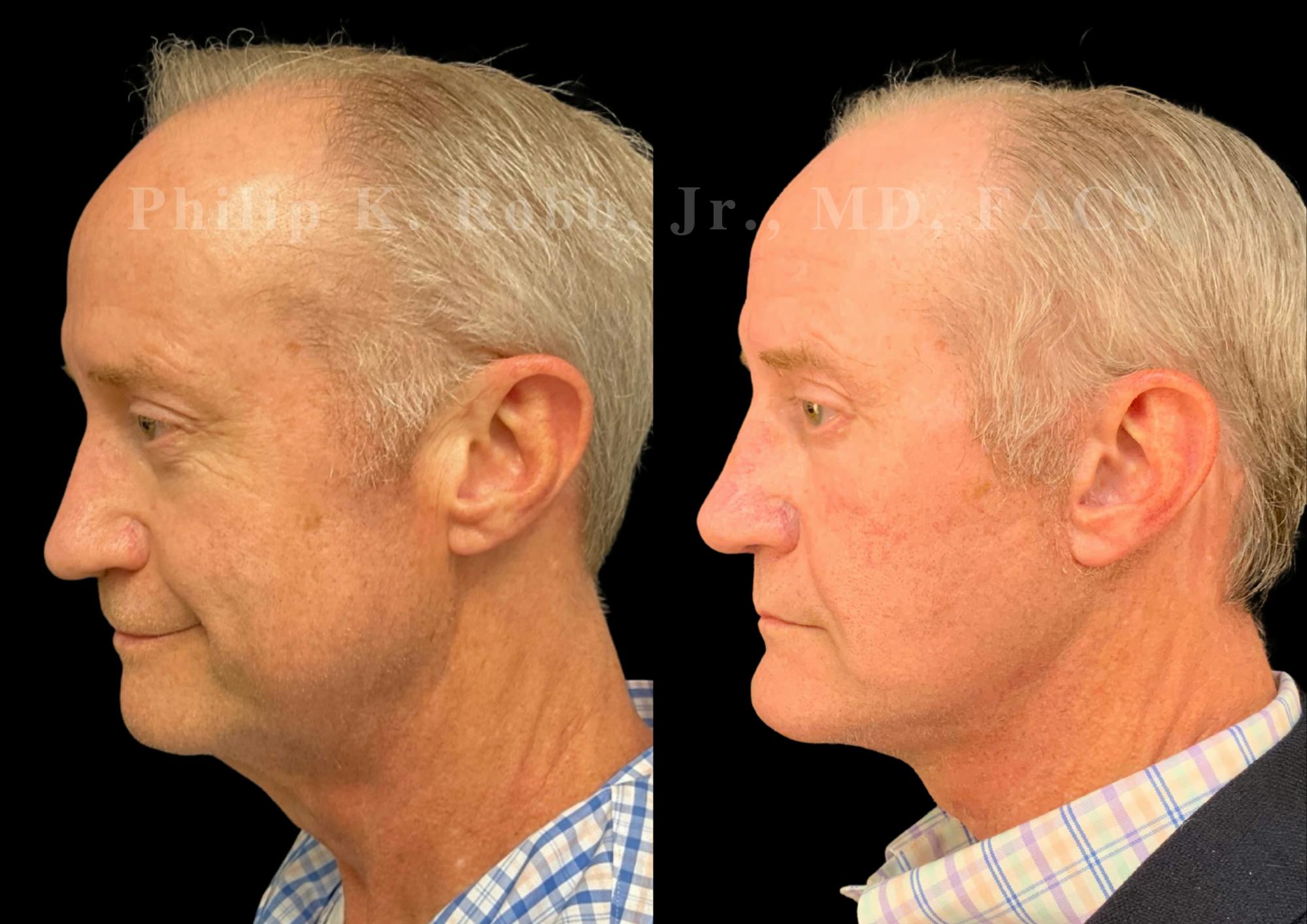 Laser Skin Resurfacing Before & After Gallery - Patient 663504 - Image 7