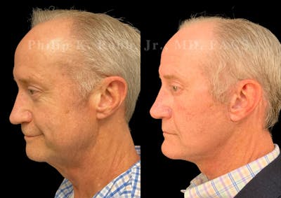 Chin Augmentation Before & After Gallery - Patient 584317 - Image 1