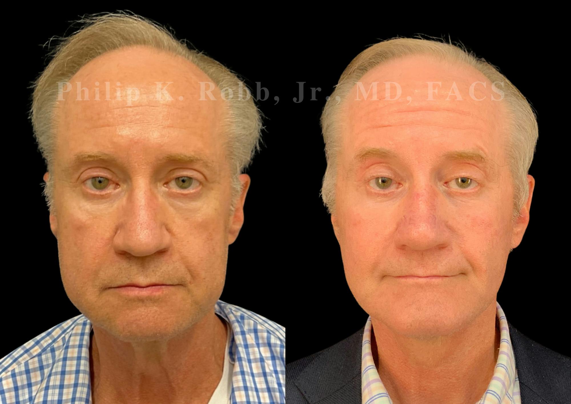 Laser Skin Resurfacing Before & After Gallery - Patient 663504 - Image 5