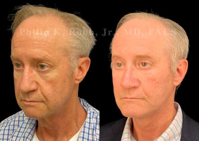 Facelift Before & After Gallery - Patient 391927 - Image 1