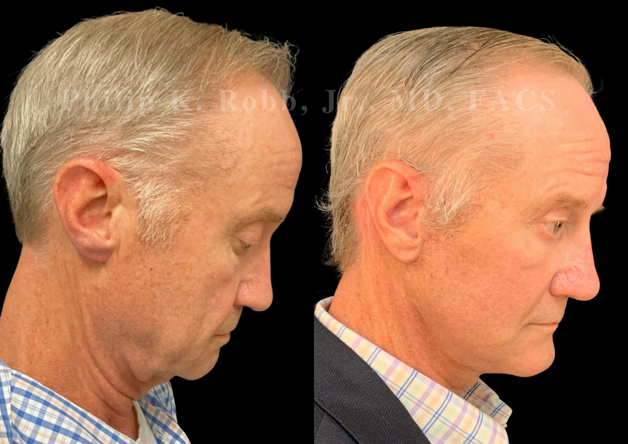 Laser Skin Resurfacing Before & After Gallery - Patient 663504 - Image 3