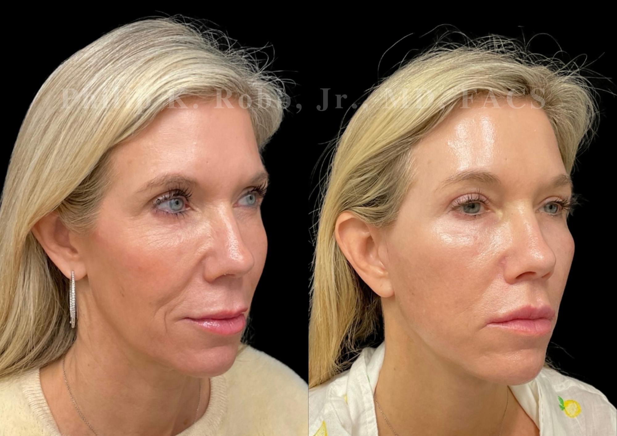 Facelift Before & After Gallery - Patient 922534 - Image 4