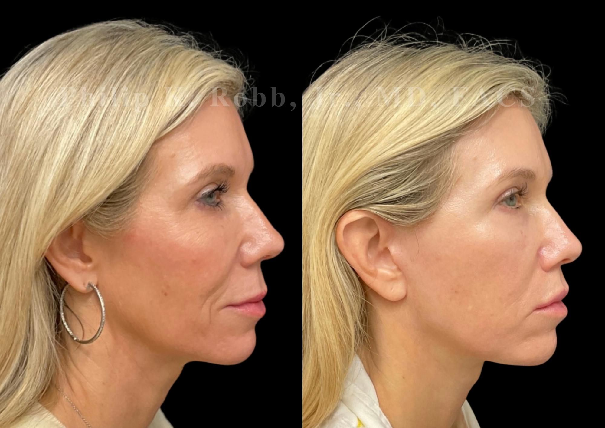 Facelift Before & After Gallery - Patient 922534 - Image 5