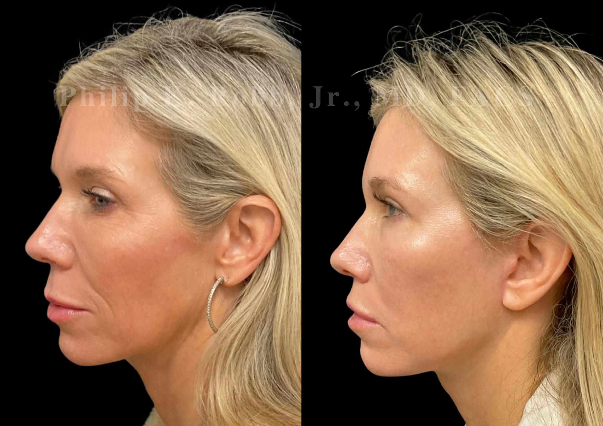 Facelift Before & After Gallery - Patient 922534 - Image 2