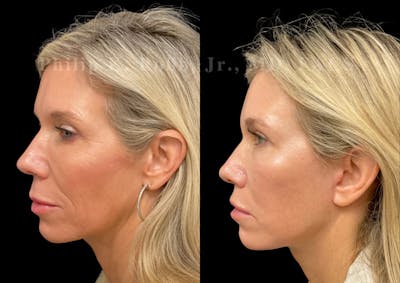 Neck Lift Before & After Gallery - Patient 147355 - Image 1