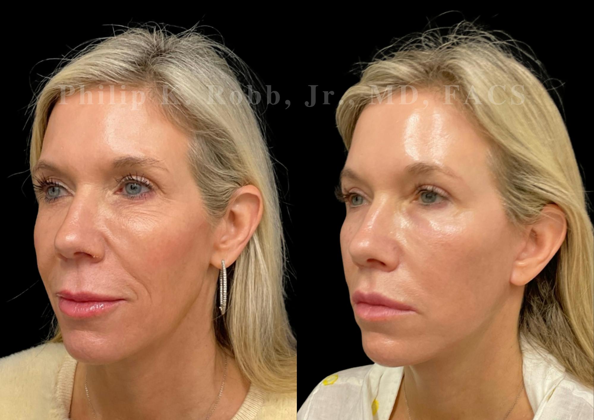 Facelift Before & After Gallery - Patient 922534 - Image 1