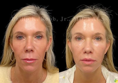 Laser Skin Resurfacing Before & After Gallery - Patient 353964 - Image 1
