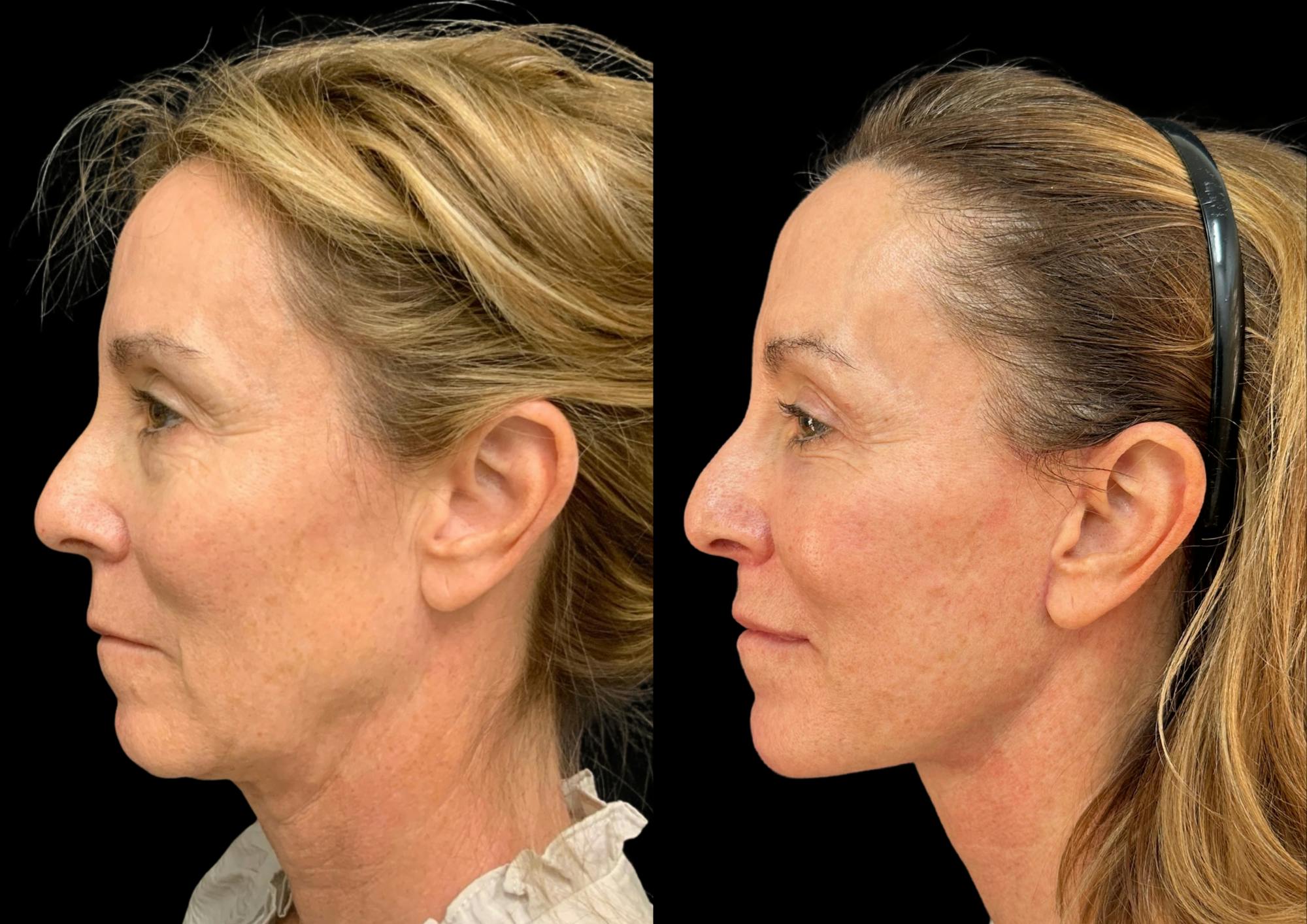 The Robb Refresh Before & After Gallery - Patient 388091 - Image 3