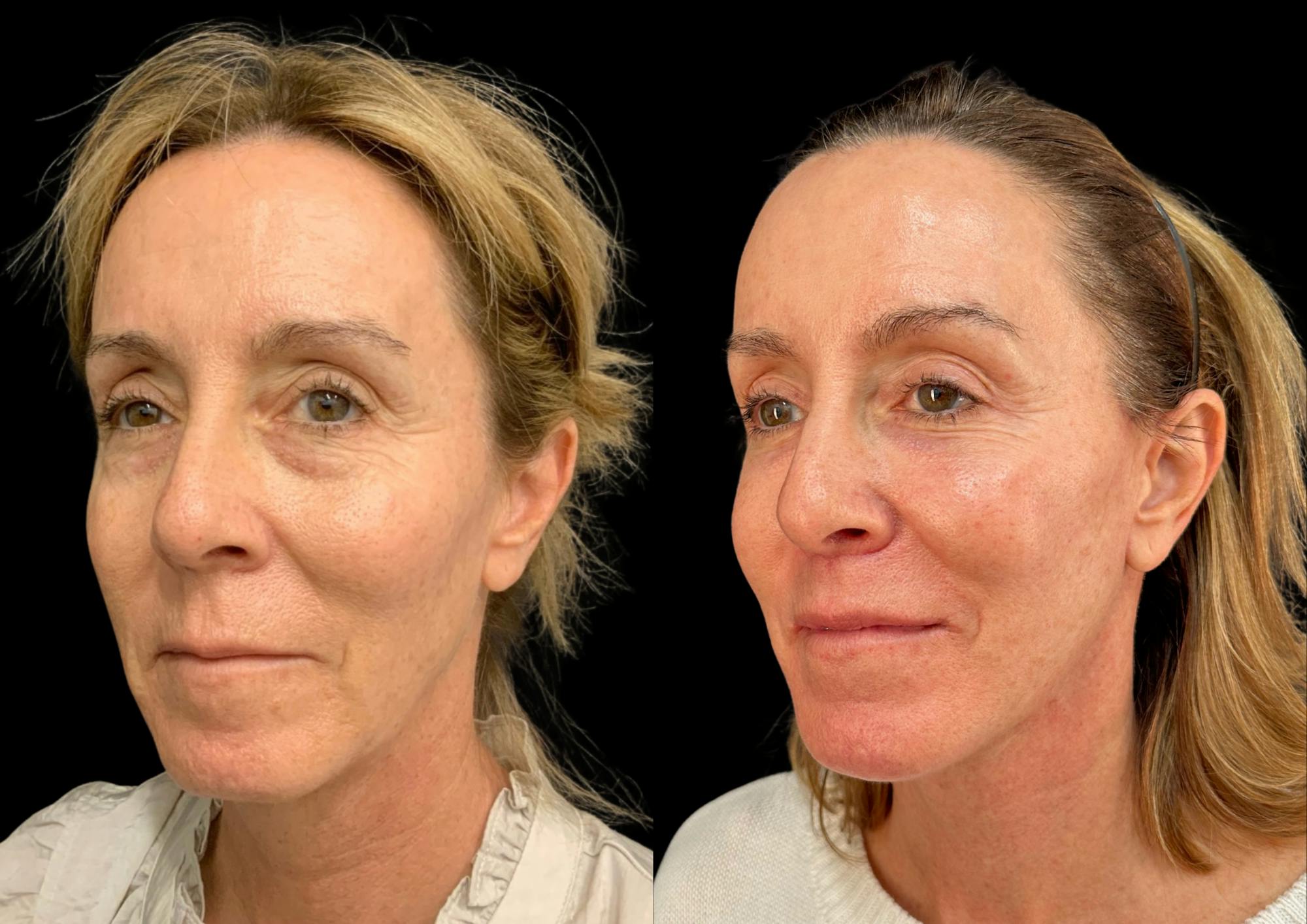 The Robb Refresh Before & After Gallery - Patient 388091 - Image 4