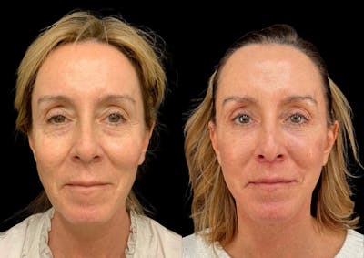 The Robb Refresh Before & After Gallery - Patient 388091 - Image 1