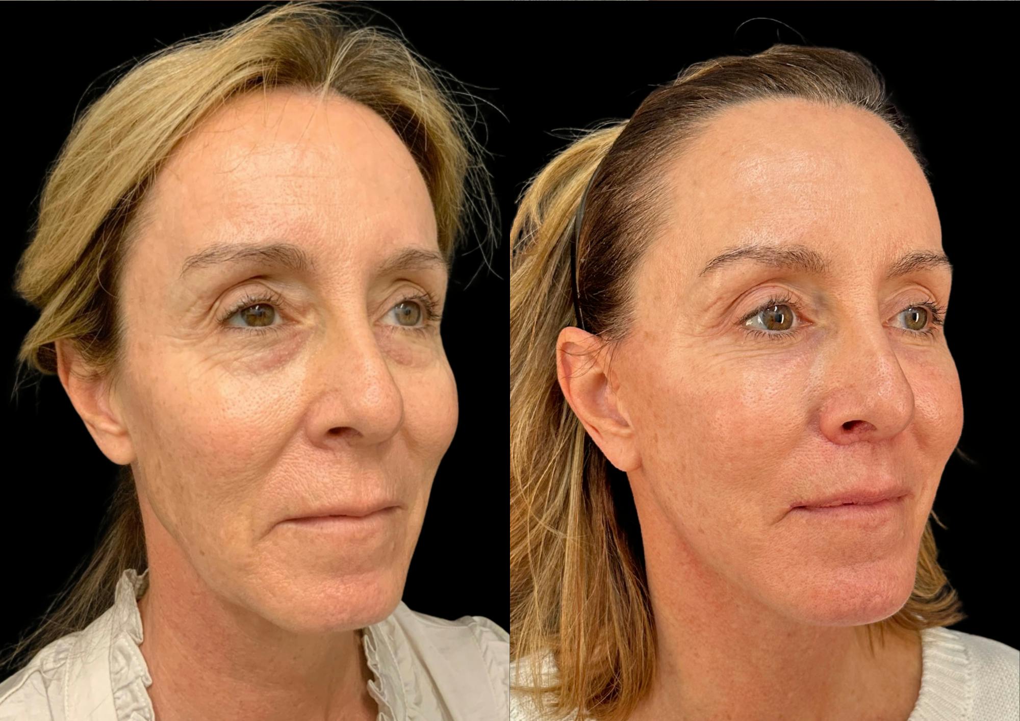 The Robb Refresh Before & After Gallery - Patient 388091 - Image 5