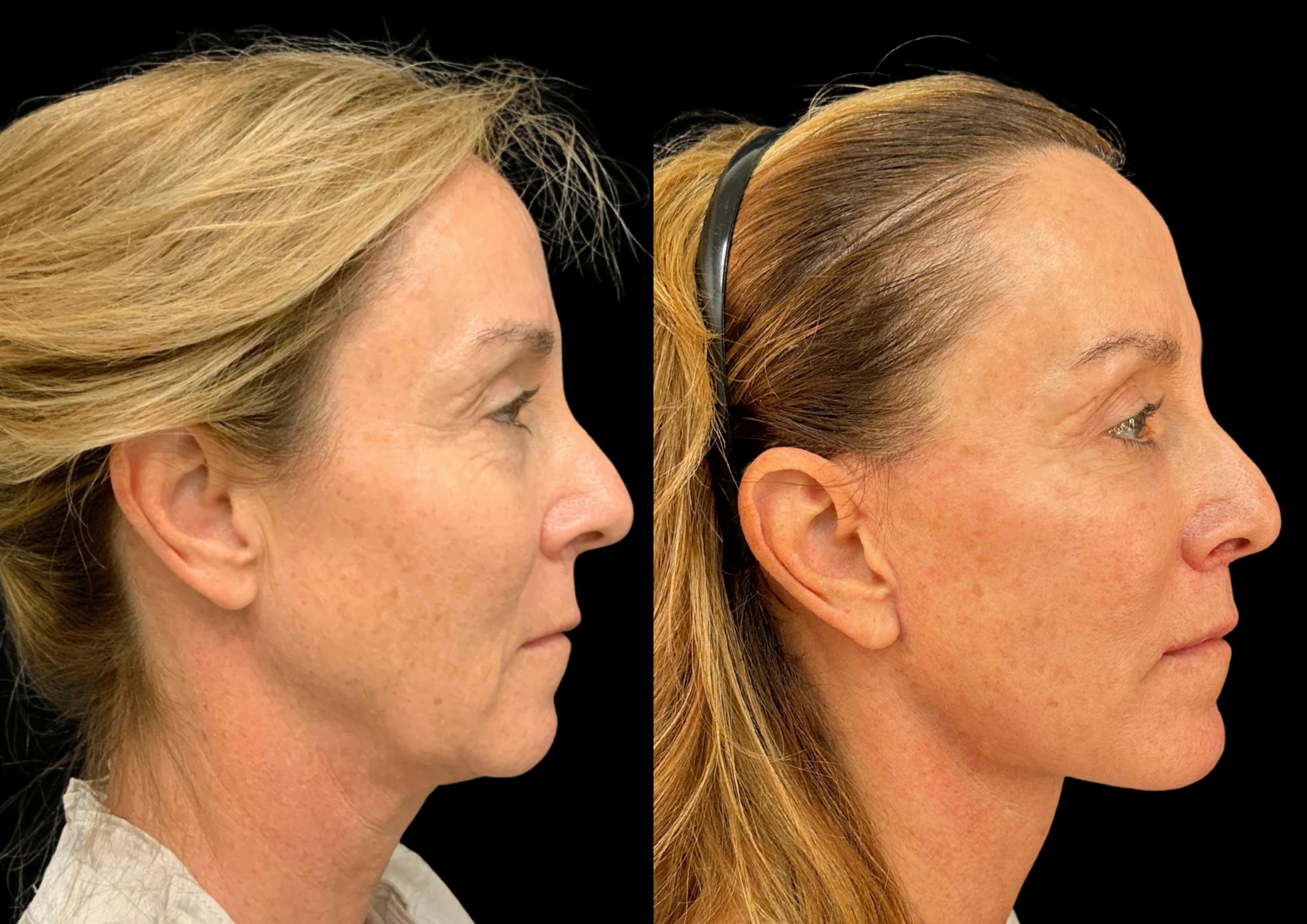 The Robb Refresh Before & After Gallery - Patient 388091 - Image 7