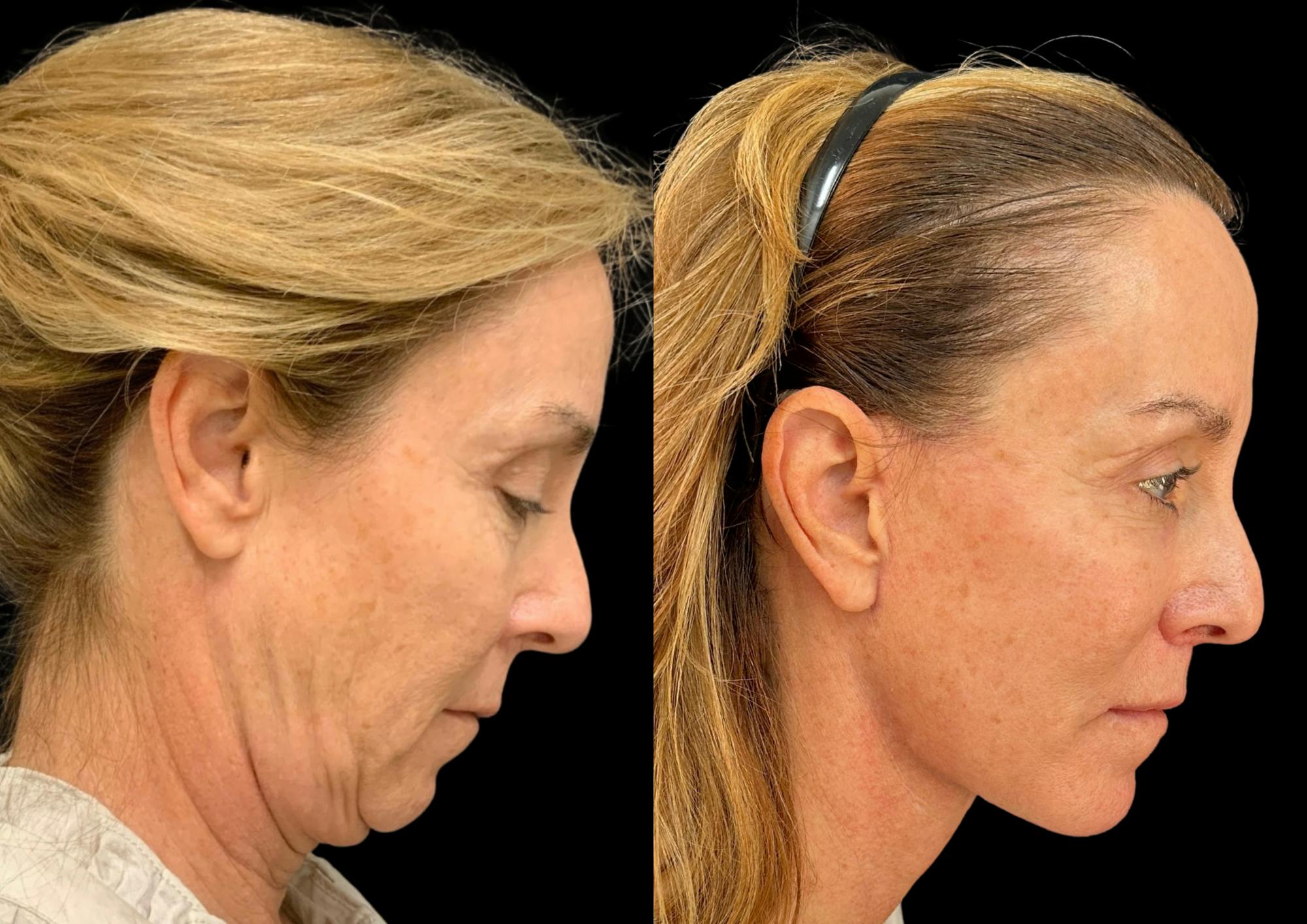 The Robb Refresh Before & After Gallery - Patient 388091 - Image 6