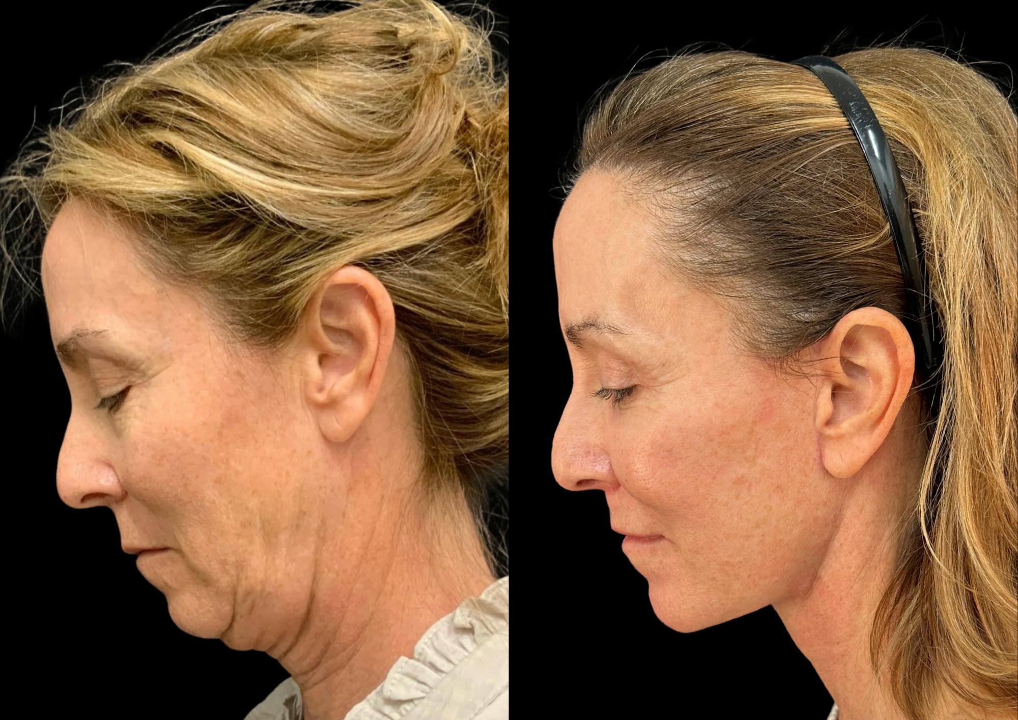 The Robb Refresh Before & After Gallery - Patient 388091 - Image 2