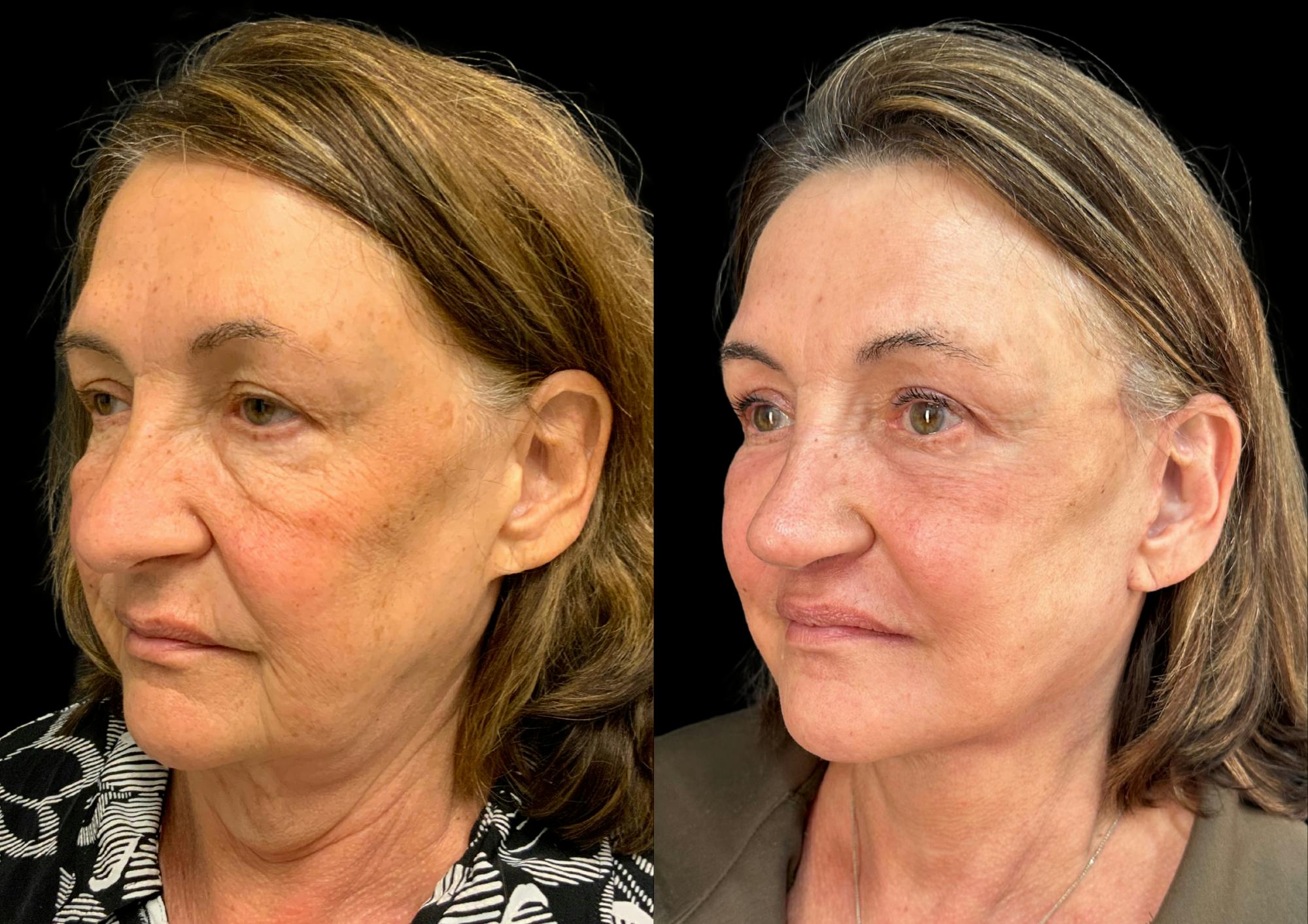 The Robb Refresh Before & After Gallery - Patient 354399 - Image 3