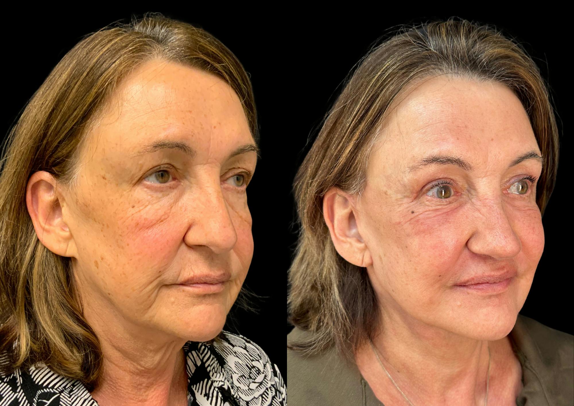 The Robb Refresh Before & After Gallery - Patient 354399 - Image 4