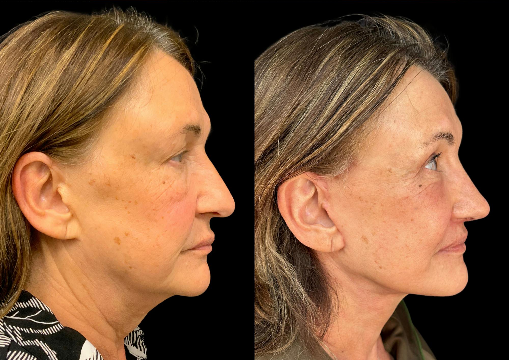 The Robb Refresh Before & After Gallery - Patient 354399 - Image 5