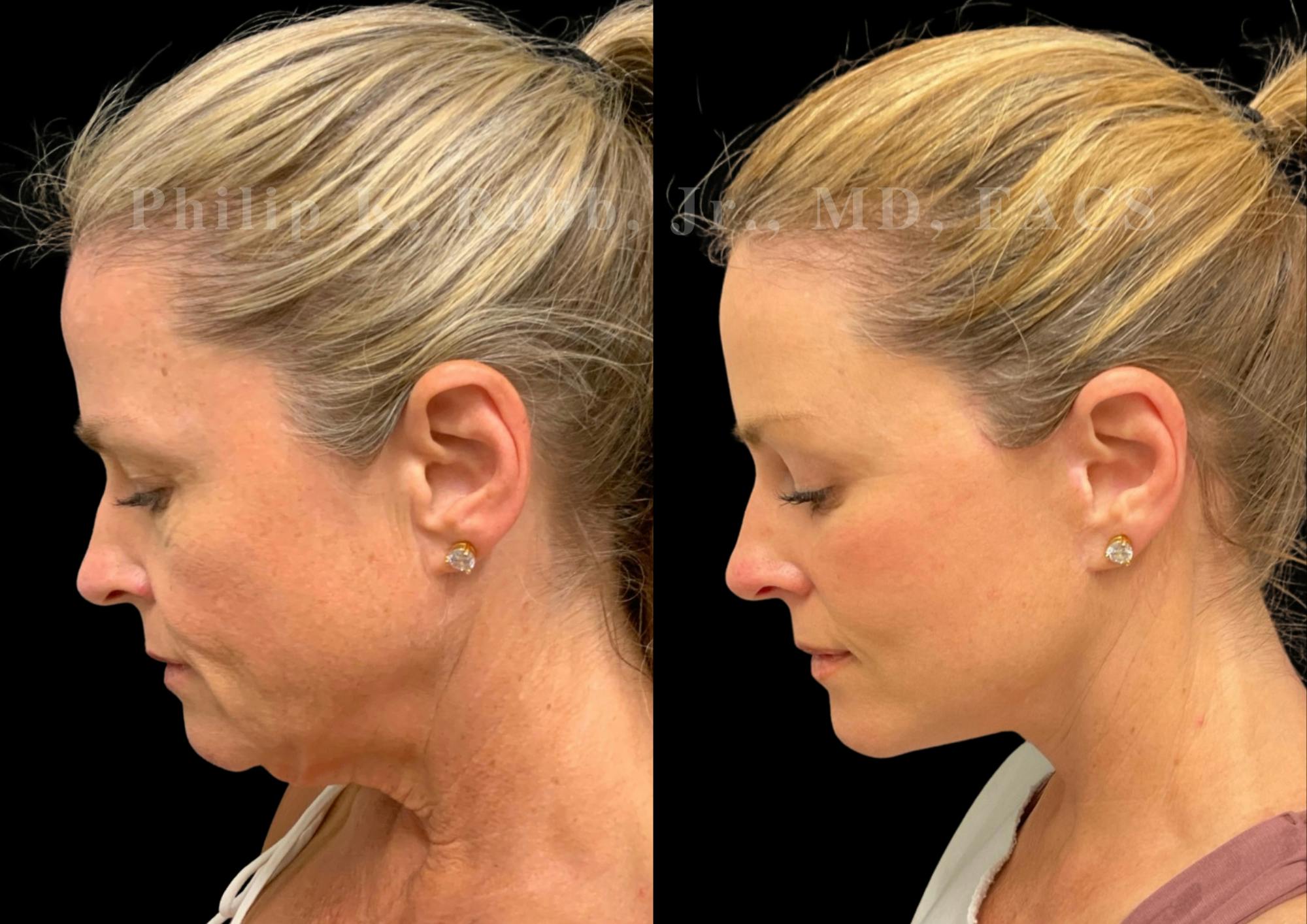 The Robb Refresh Before & After Gallery - Patient 306793 - Image 2