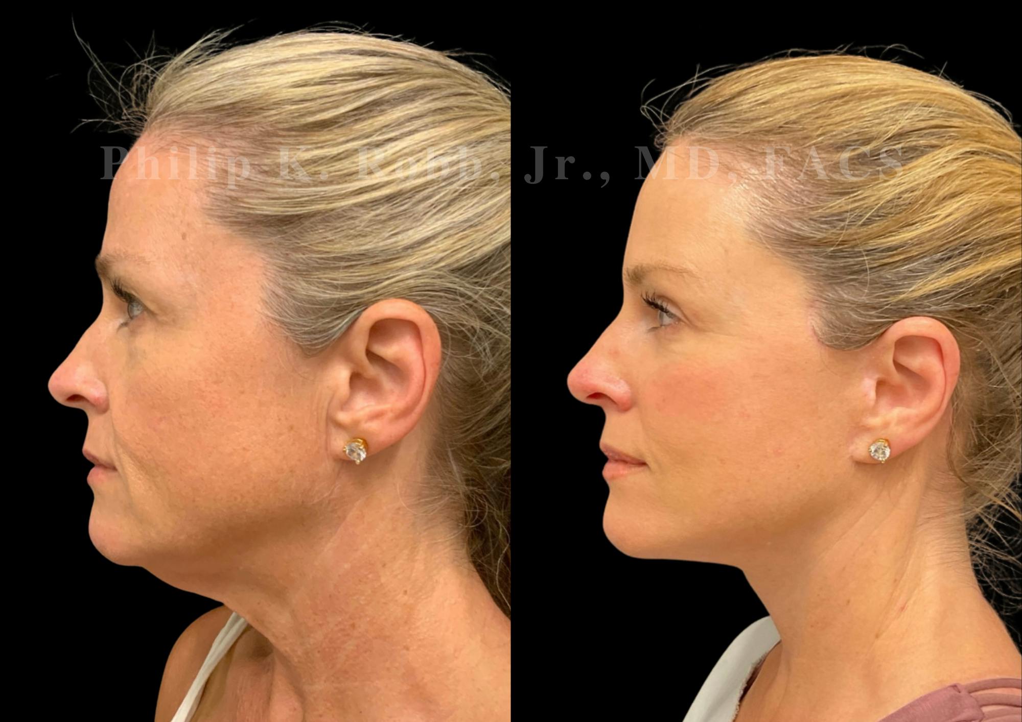 The Robb Refresh Before & After Gallery - Patient 306793 - Image 3