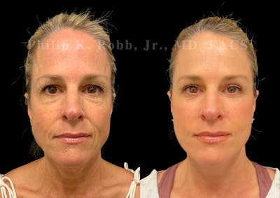The Robb Refresh Before & After Gallery - Patient 306793 - Image 1