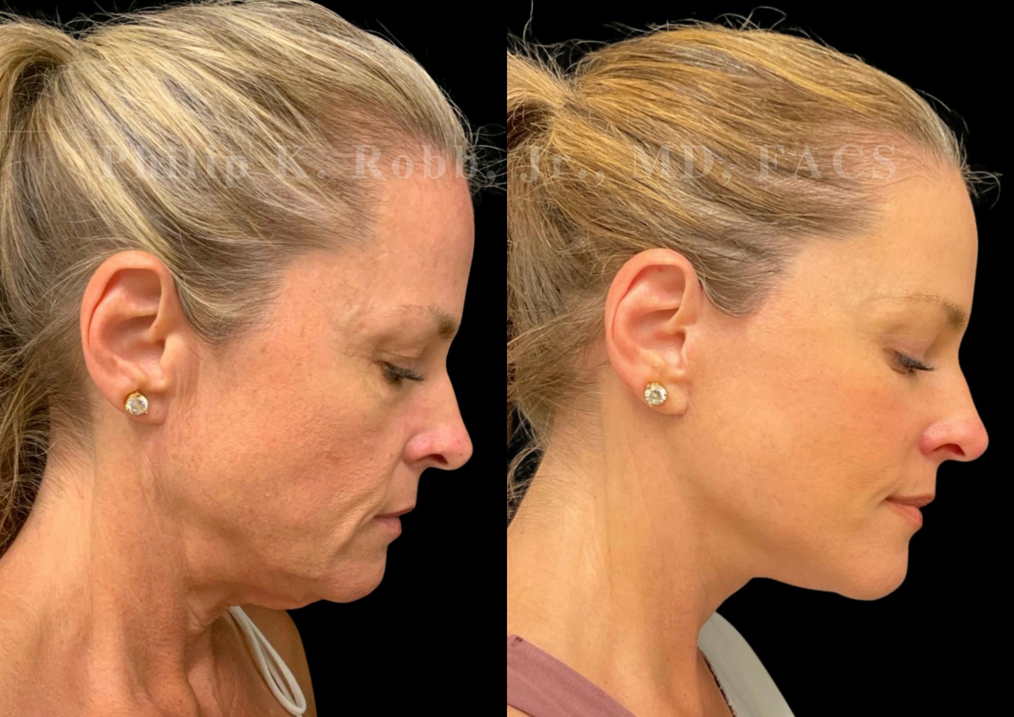 The Robb Refresh Before & After Gallery - Patient 306793 - Image 7