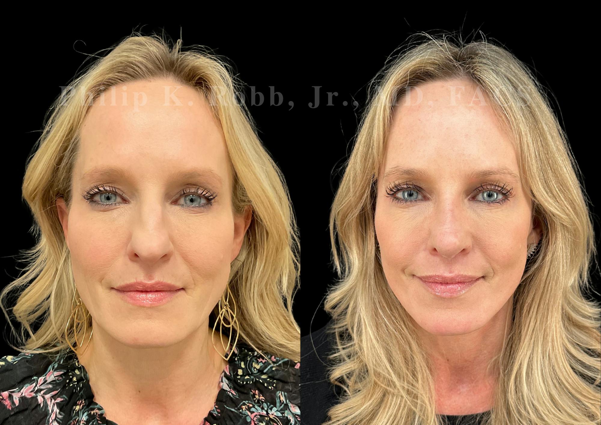 The Robb Refresh Before & After Gallery - Patient 420003 - Image 1