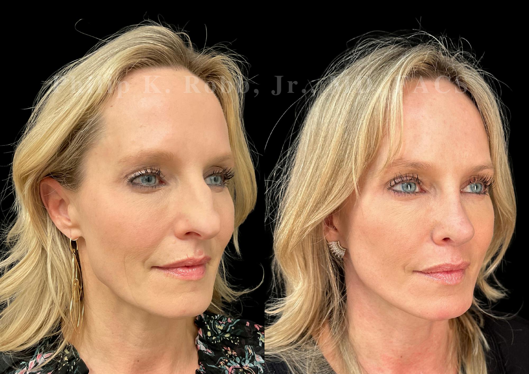 The Robb Refresh Before & After Gallery - Patient 420003 - Image 4