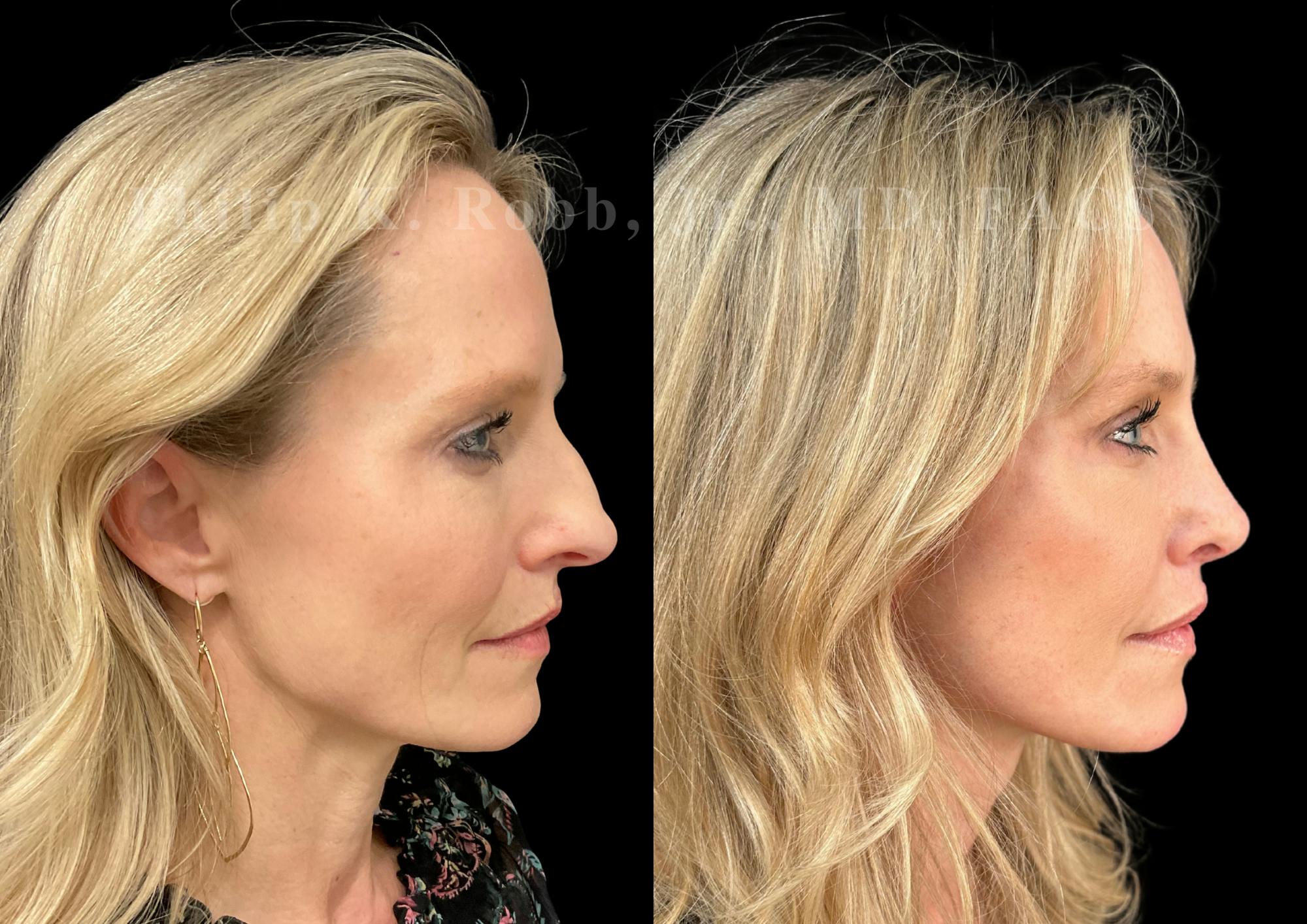 The Robb Refresh Before & After Gallery - Patient 420003 - Image 5