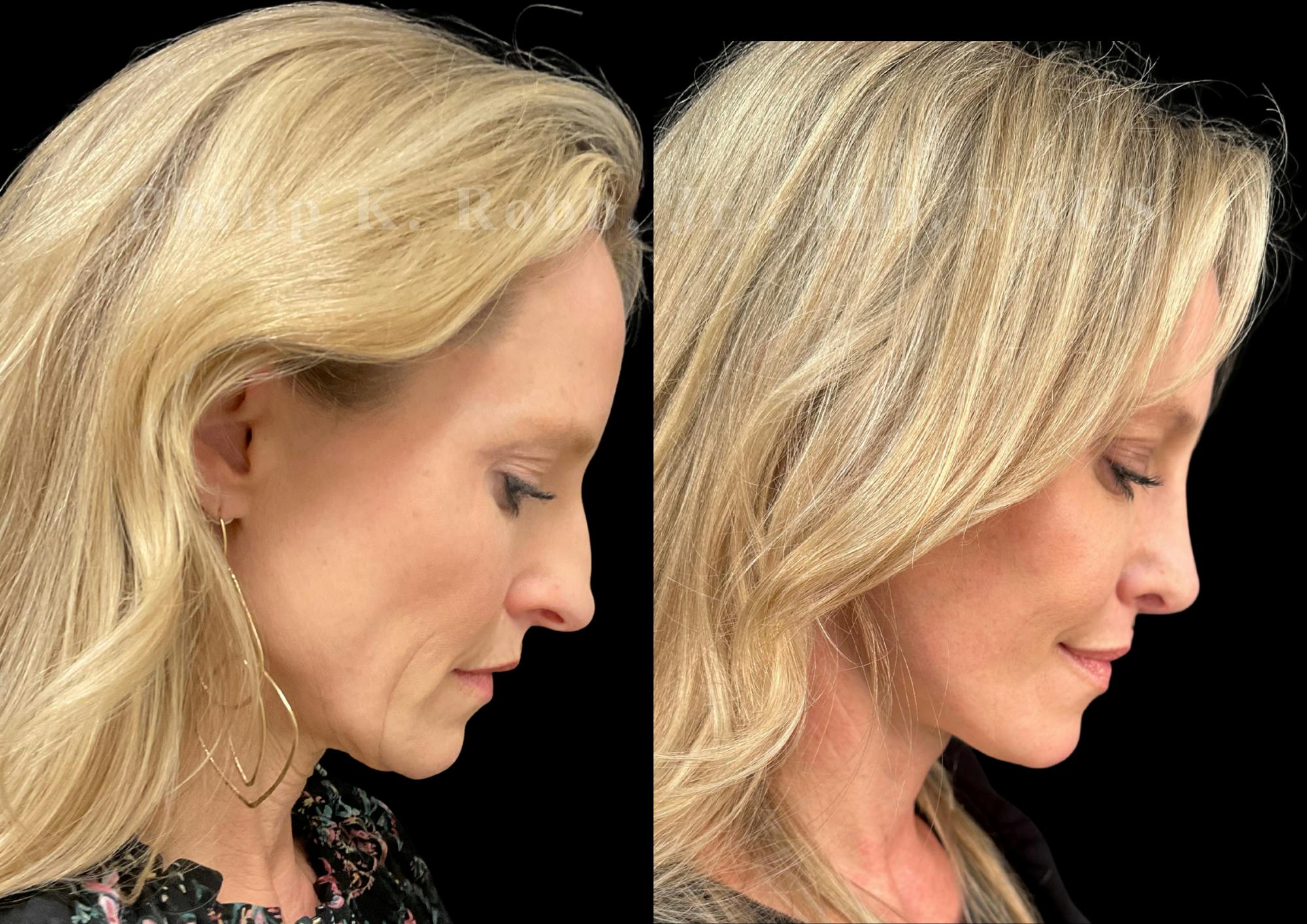 The Robb Refresh Before & After Gallery - Patient 420003 - Image 6