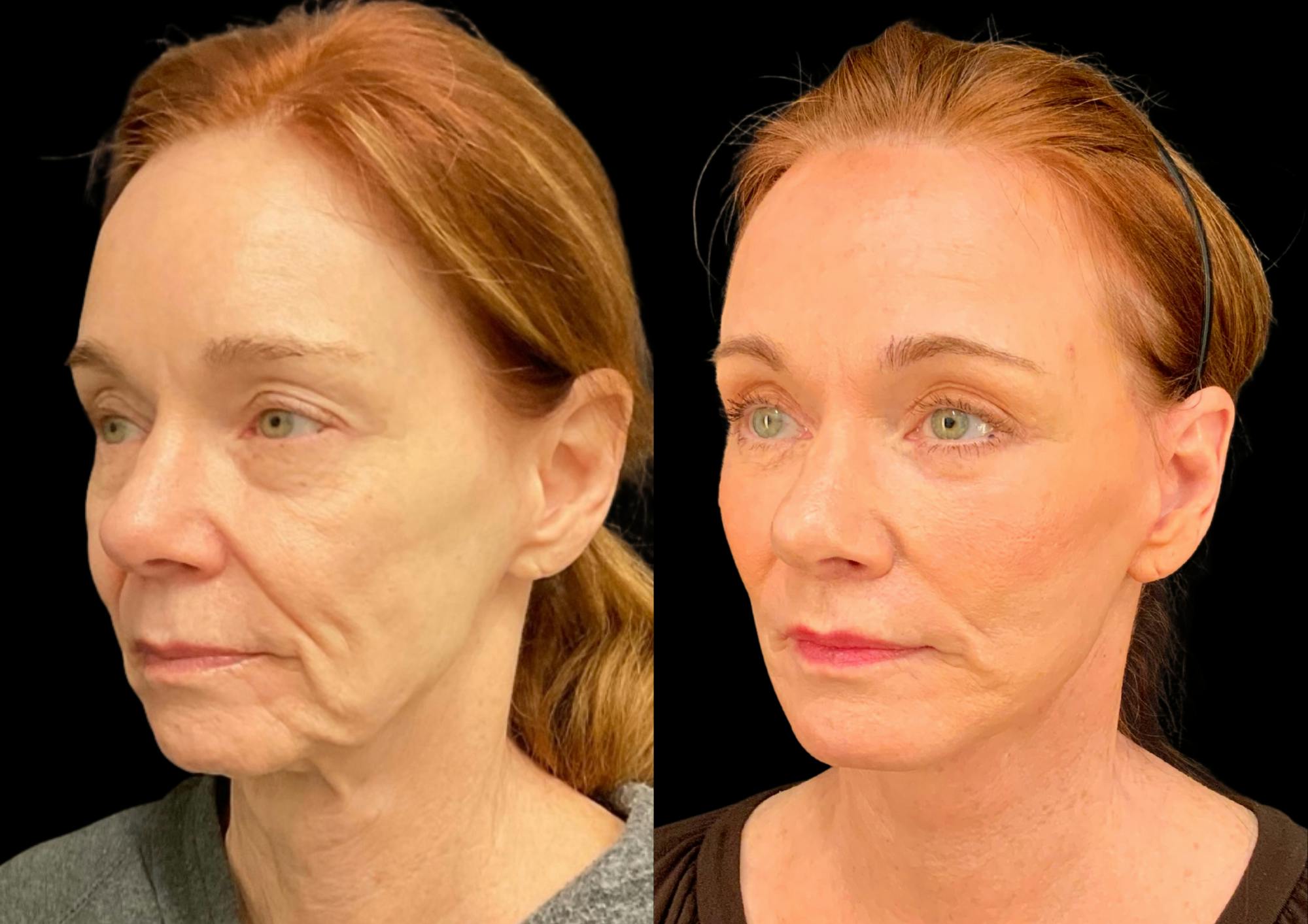 Fat Transfer Before & After Gallery - Patient 111376 - Image 4