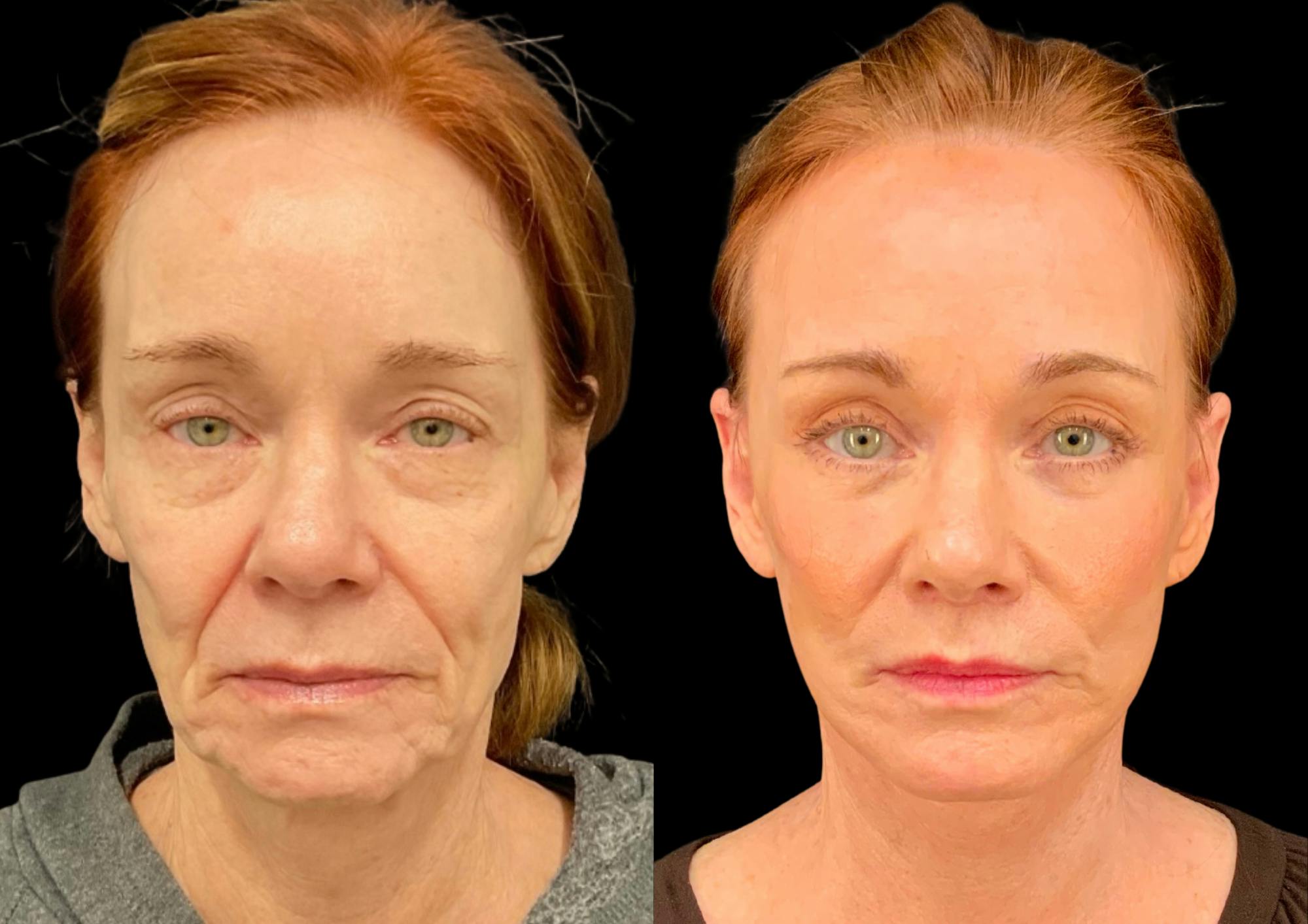 Fat Transfer Before & After Gallery - Patient 111376 - Image 1