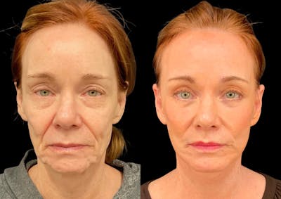 Fat Transfer Before & After Gallery - Patient 111376 - Image 1