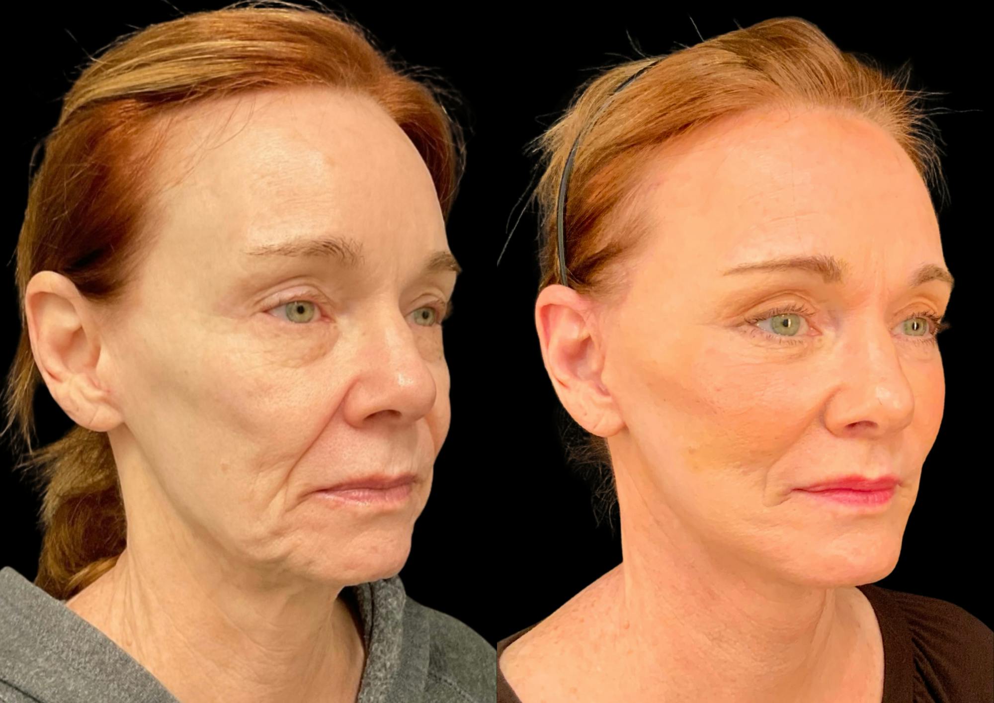 Fat Transfer Before & After Gallery - Patient 111376 - Image 5