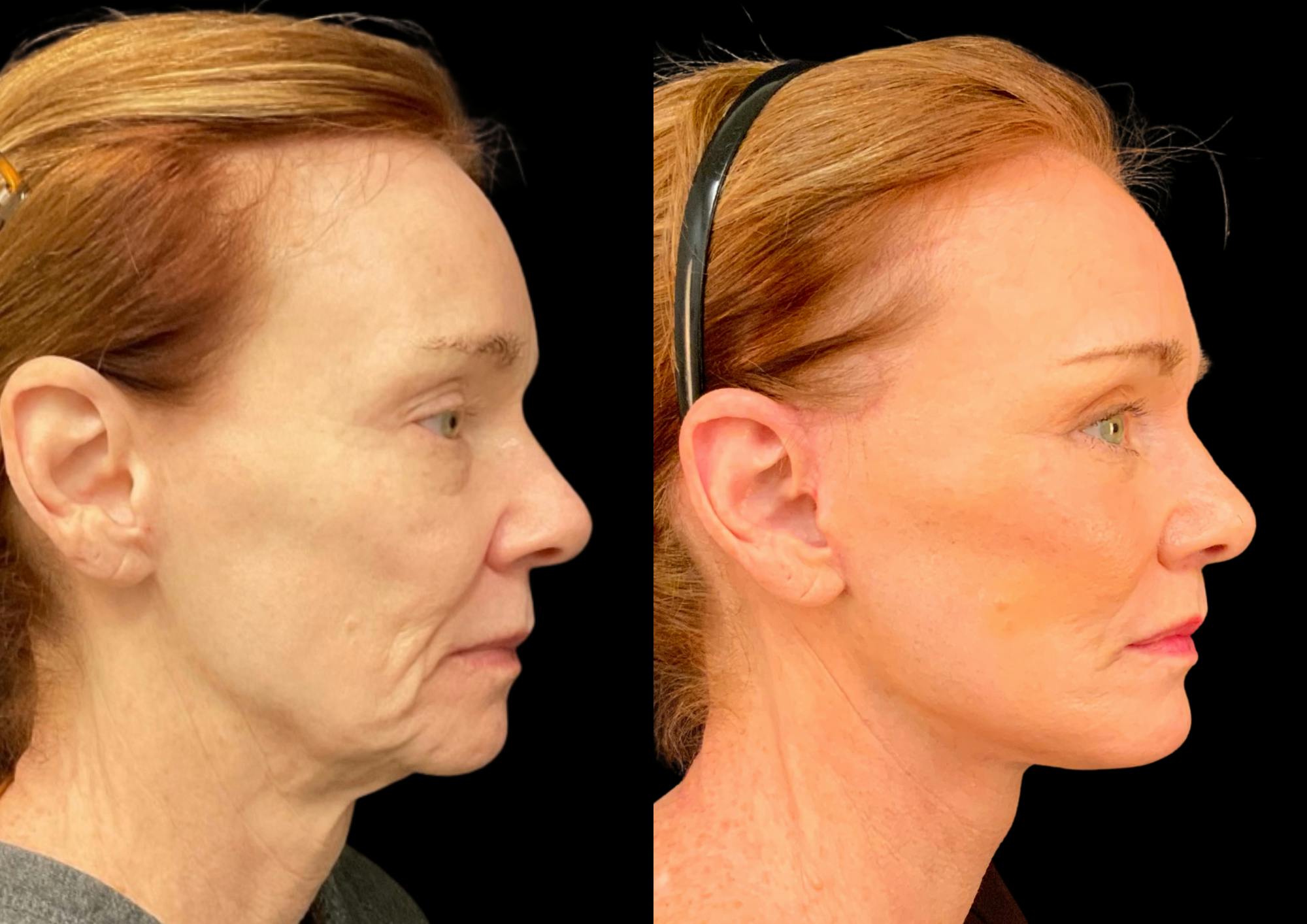 Fat Transfer Before & After Gallery - Patient 111376 - Image 6