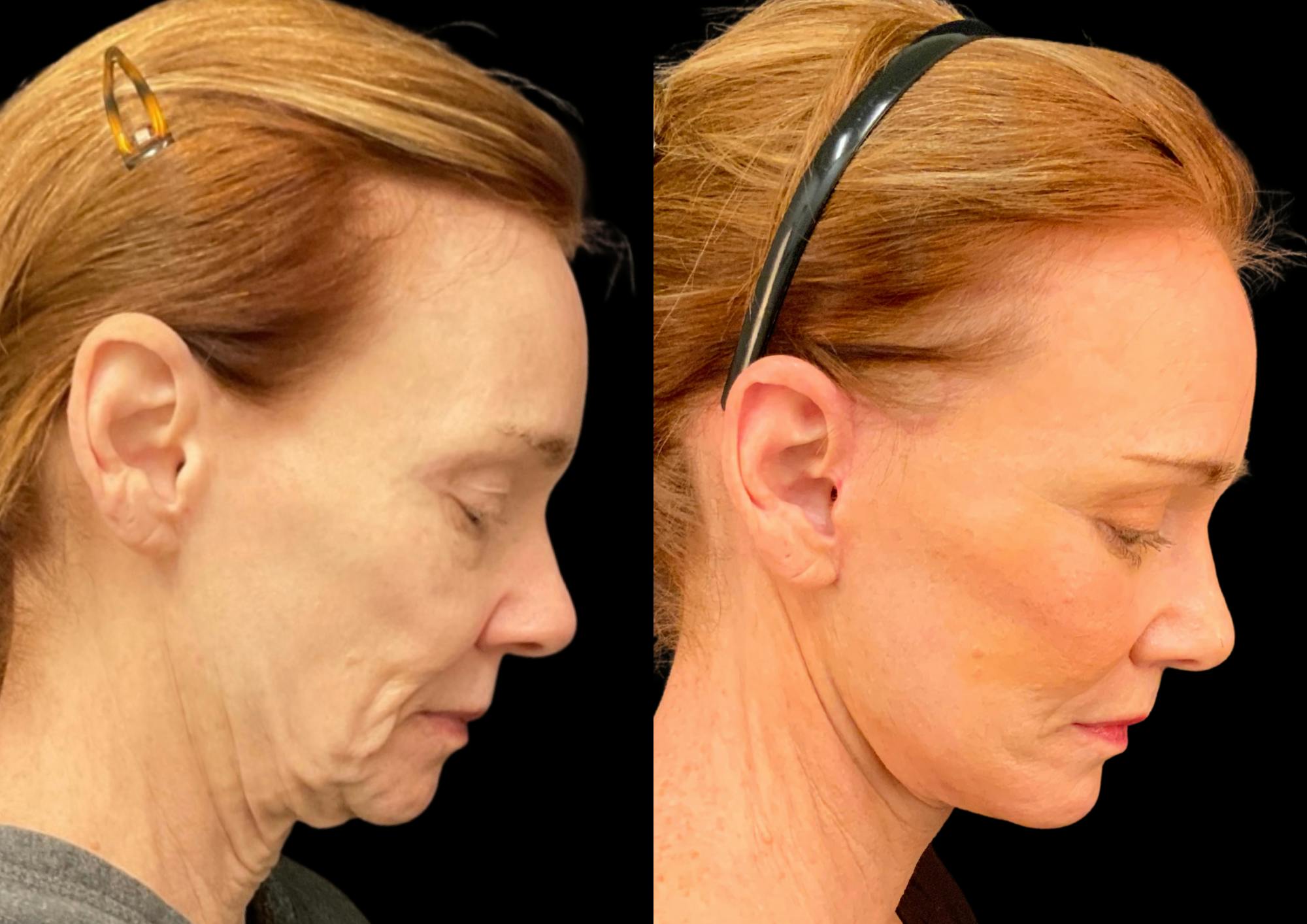 Fat Transfer Before & After Gallery - Patient 111376 - Image 7