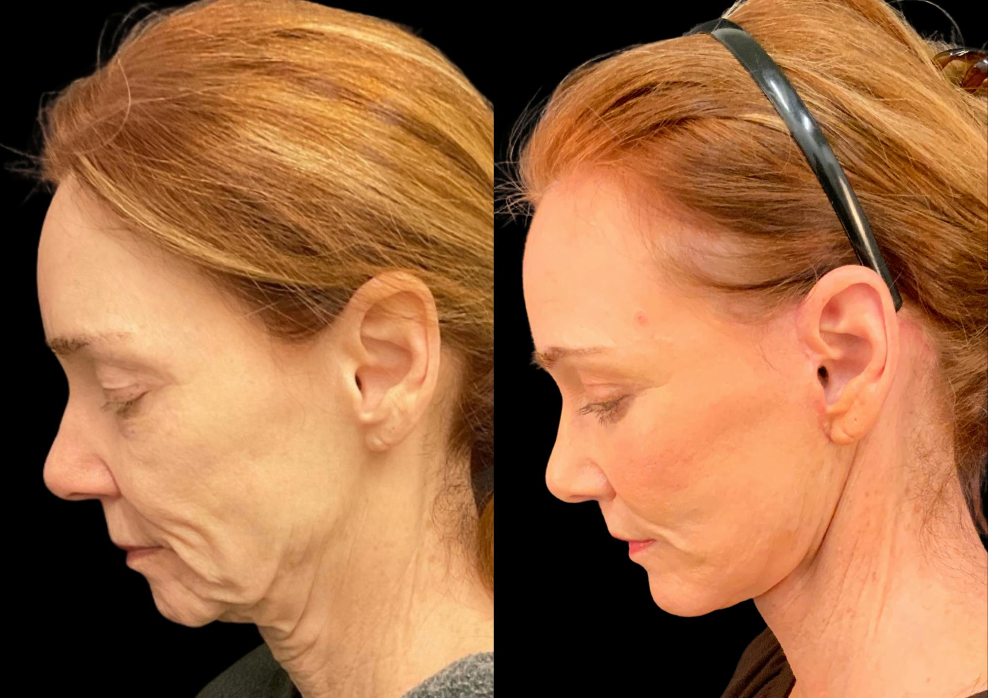 Fat Transfer Before & After Gallery - Patient 111376 - Image 2