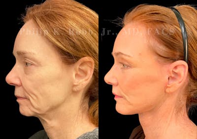 Neck Lift Before & After Gallery - Patient 717494 - Image 1