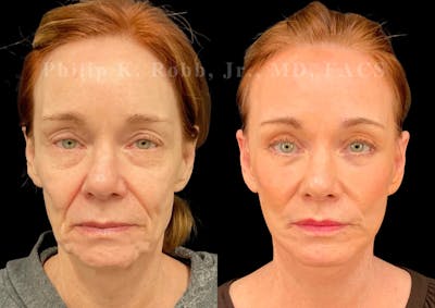Upper Blepharoplasty Before & After Gallery - Patient 120894 - Image 1