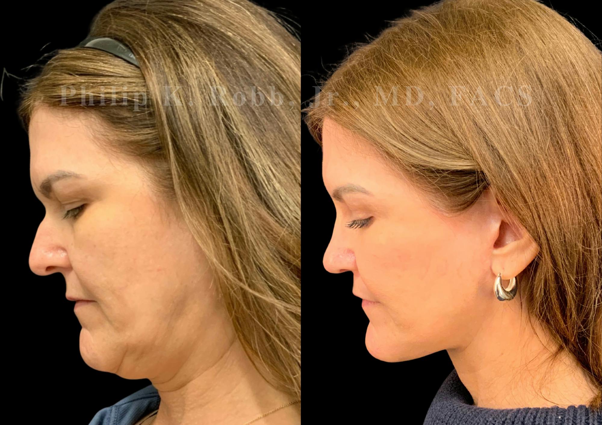 The Robb Refresh Before & After Gallery - Patient 301601 - Image 2