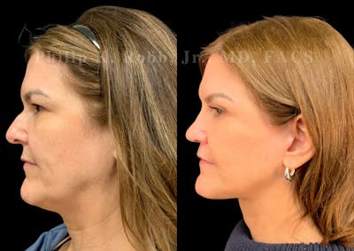 Neck Lift Before & After Gallery - Patient 188605 - Image 1