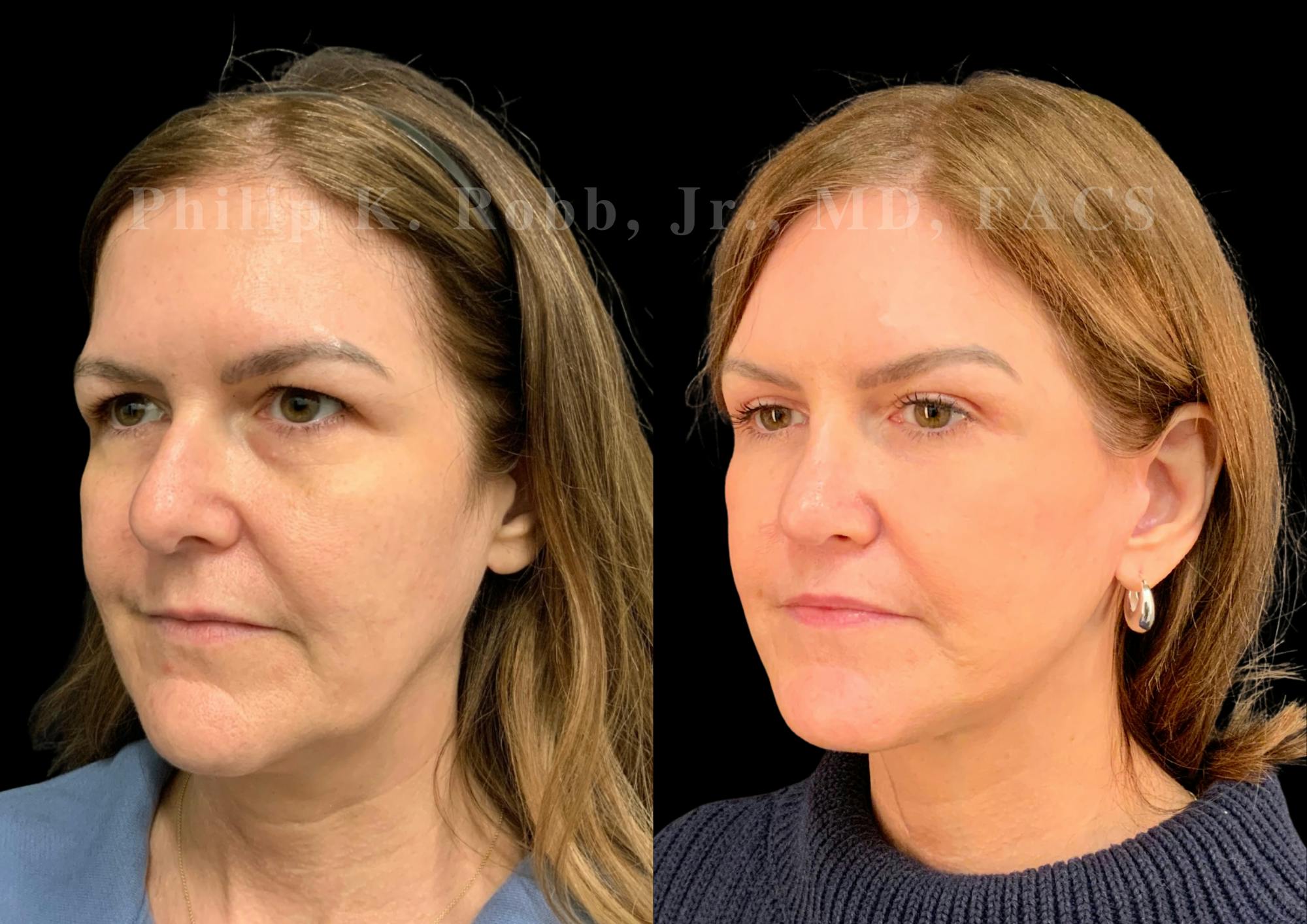 The Robb Refresh Before & After Gallery - Patient 301601 - Image 4