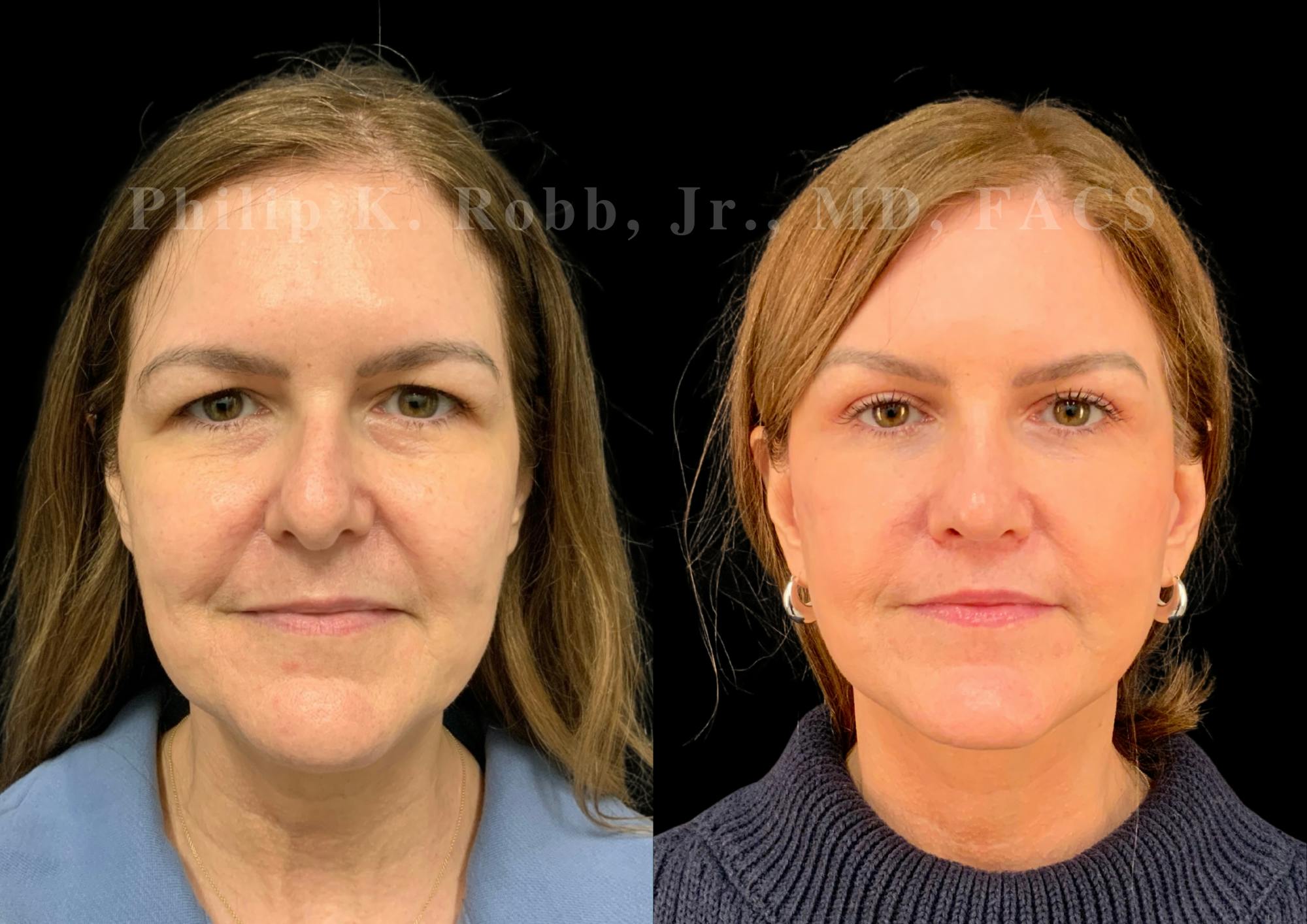 The Robb Refresh Before & After Gallery - Patient 301601 - Image 1